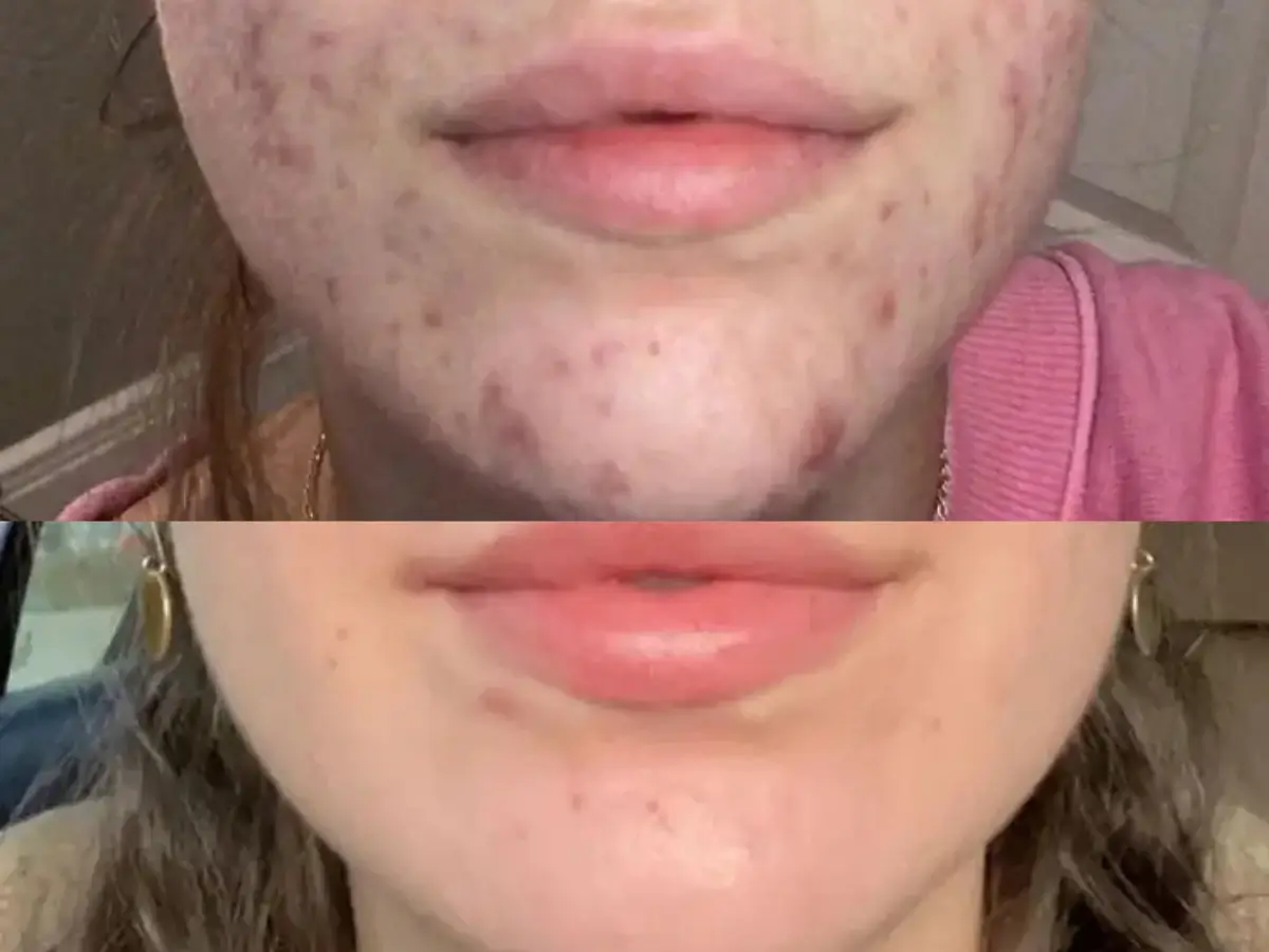 Antes e Depois Selfie Real