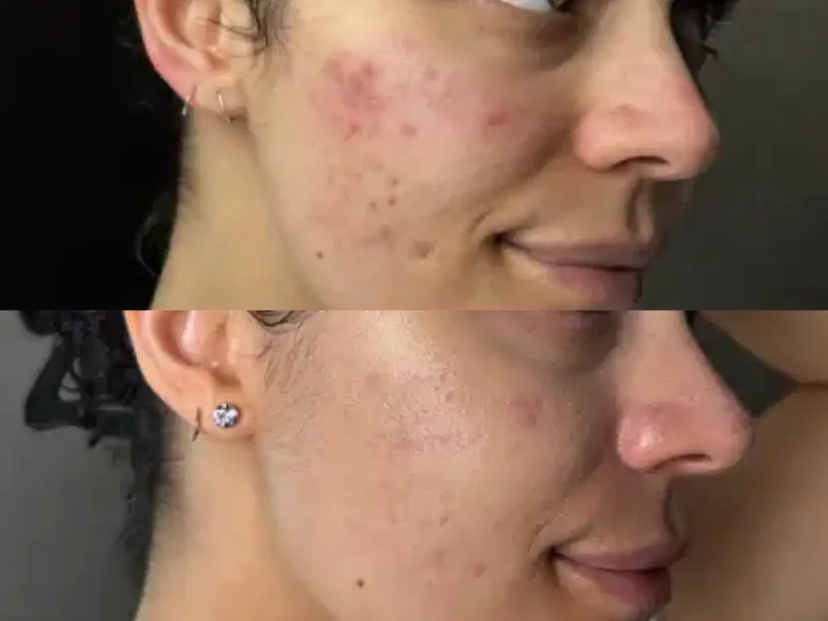Antes e Depois Textura