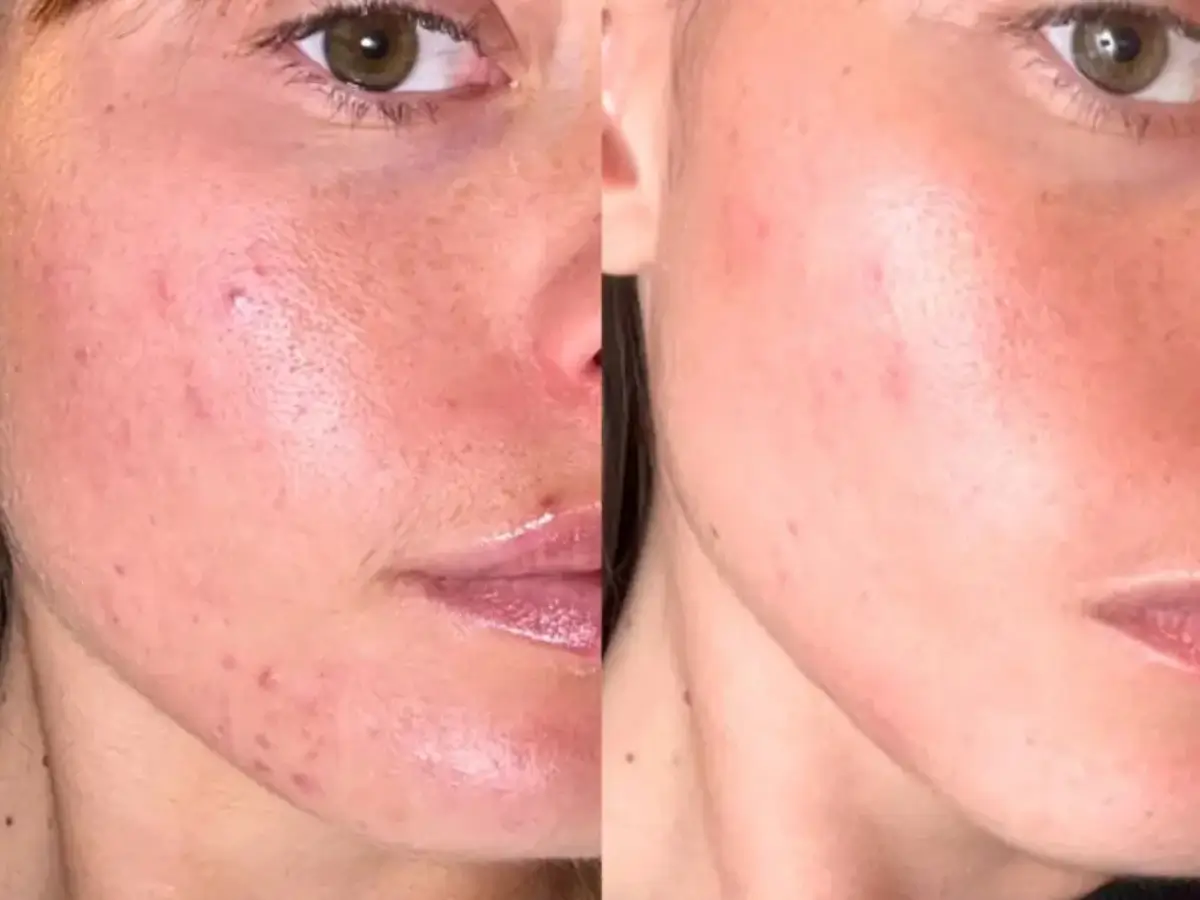 Antes e Depois Vermelhidão